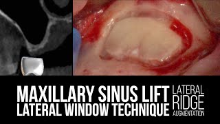 Maxillary Sinus Lift with Lateral Window Technique with Lateral Ridge Augmentation [upl. by Nosahc599]