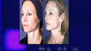 REJUVENATION FACIALE Laser CO2 Micro Fractionné MiXto Essonne [upl. by Jacquetta47]