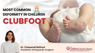 Clubfoot  Complete Information Diagnosis Exercise Treatment at Home Shoes Surgery [upl. by Eicrad]