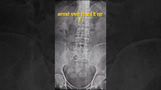 Kidney Stone Dikhai de raha hai [upl. by Enirol564]