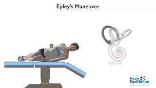 Epley Maneuver A Step by Step Guide to Treat BPPV Vertigo [upl. by Eidson]