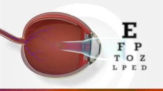 What is myopia  3D animation of myopia [upl. by Nodnas]