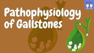 Gallstones Pathophysiology Cholecystitis Choledocholithiasis Diagnosis ComplicationsTreatment [upl. by Zehcnas]