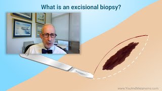 What kind of biopsies are used for melanoma [upl. by Yldarb703]