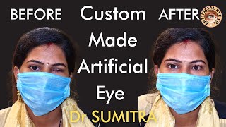 Best Artificial Eye With Eye Movements  Prosthetic eye by Dr Sumitra  Best Ocularist पत्थर का आँख [upl. by Wolf328]