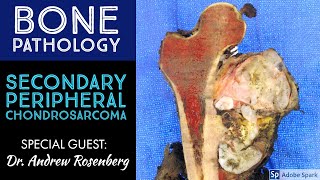 Secondary Peripheral Chondrosarcoma from OsteochondromaExostosis Bone Pathology with Dr Rosenberg [upl. by Ceporah]