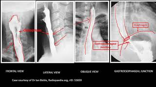 Abdominal XRay Barium swallow Barium Meal and Barium Enema [upl. by Manning]