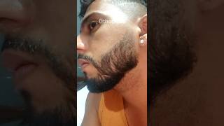 5 MESES de TRATAMENTO COM MINOXIDIL evolução minoxidil barba minoxidil thedicas [upl. by Jared]