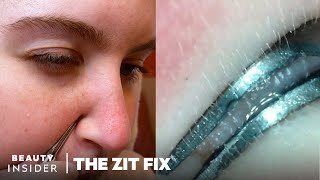 Blackhead Tweezers Under The Microscope  The Zit Fix  Beauty Insider [upl. by Hairem]