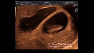 How is an 8 weeks dichorionic diamniotic twin pregnancy seen on ultrasound Possible lambda sign [upl. by Narmis]