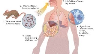 Hantavirus Treatment [upl. by Tnias]