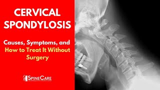 CERVICAL SPONDYLOSIS Causes Symptoms and Treatment NO SURGERY [upl. by Ellyn]