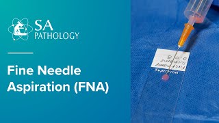 Fine Needle Aspiration Biopsy  FNA [upl. by Aicillyhp]