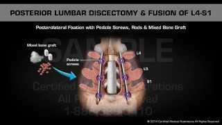 Posterior Lumbar Discectomy amp Fusion of L4S1 [upl. by Itsim]