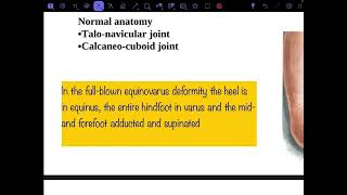 Congenital talipes equinovarus part 1 [upl. by Annoved]