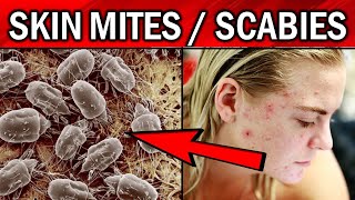 8 Effective Remedies To Get Rid of Skin MitesScabies Naturally [upl. by Niahs]