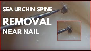 Sea urchin spine removal near nail [upl. by Adal]