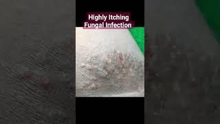 Highly Itching Fungal Infection  Ringworm of Groin  Tinea cruris [upl. by Akimyt673]