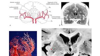 The lenticulostriate vessels and lacunar infarcts [upl. by Mireille]