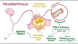 Syphilis  Traponema Pallidum  Osmosis [upl. by Allertse124]