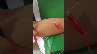 Tennis Elbow Pain Treatment by Acupuncture needles tens [upl. by Jonme]