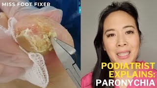 Emergency Nail Infection Treatment Quick Paronychia Relief While Traveling  Miss Foot Fixer [upl. by Aleahc68]