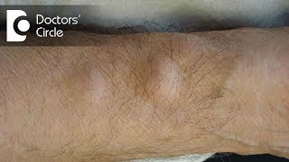 Does painful lump present on body indicate Lipoma  Dr Nanda Rajaneesh [upl. by Ynobe256]