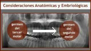 Exodoncia de cordal incluido [upl. by Aicatan]