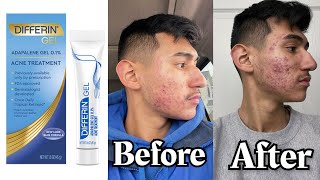 My 6 month Expirience with Differin Gel Adapalene  My Acne Journey [upl. by Wie]