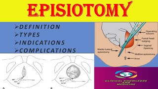 Episiotomy Definition Indications Types Complications [upl. by O'Mahony]