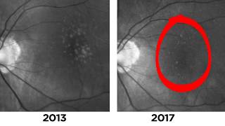 Two Cases of Disappearing Drusen in Patients with AMD [upl. by Anenahs]