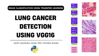 Lung Cancer Detection using VGG16  Image Classification using Transfer Learning [upl. by Aidas]