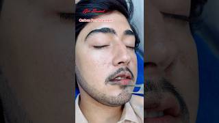 Carbon Peel Laser Treatment getsmarthairclub viralvideo beauty laserhairtreatment laser [upl. by Trometer869]