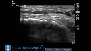 Tibialis Anterior Rupture II [upl. by Jasisa]