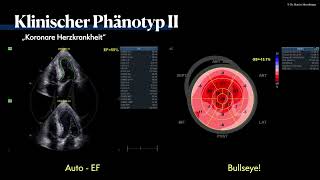 〖Echokardiografie〗 Koronare Herzerkrankung  HFpEF Phänotyp🫀 [upl. by Eikkin]