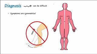 GuillainBarre Syndrome GBS Described Concisely [upl. by Nneb]