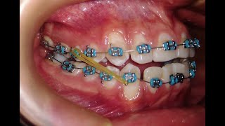 Elásticos Intermaxilares  Mira como ayudan en tu tratamiento con brackets☝ [upl. by Dwinnell]