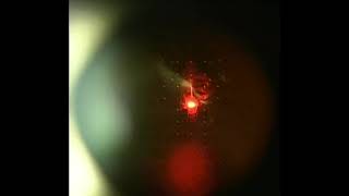 Eye Floater Laser Vitreolysis Patient of Scott Geller MD [upl. by Ylrebma]