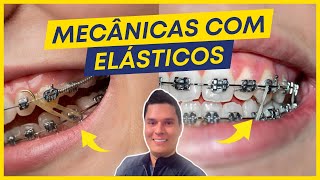 ELÁSTICOS ORTODÔNTICOS PRINCIPAIS INDICAÇÕES E EFEITOS NOS DENTES [upl. by Ettelracs]