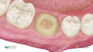 La endodoncia paso a paso [upl. by Siuqaj]