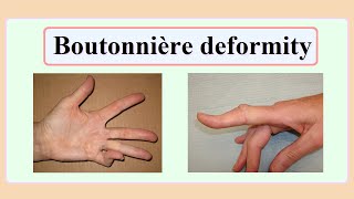 boutonnière deformity [upl. by Iridis]