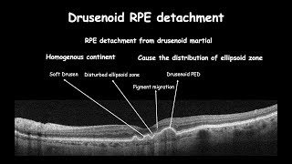 Clinical changes in RPE course  Drusen [upl. by Profant328]