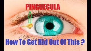 What is pinguecula  hindi पिंग्यूक्लूला क्या है [upl. by Akimak831]