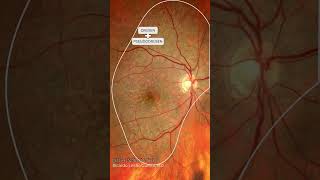 Drusen and Reticular pseudodrusen Subretinal drusenoid deposits [upl. by Idissac]