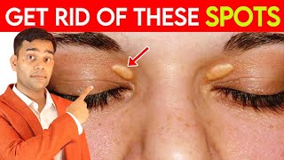 Get Rid Of These Spots  Fat Under Eyes  Xanthelasma  Natural Remedies  Dr Vivek Joshi [upl. by Laure649]