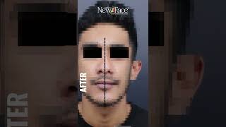 Facial Asymmetry Correction  Good Facial Appearance  Best Facial Plastic Surgeon in Kerala [upl. by Enifesoj]