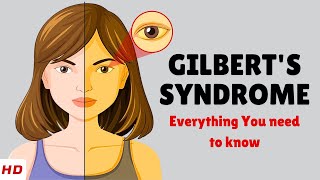 Gilberts Syndrome – Causes Signs and Symptoms Diagnosis amp Treatment [upl. by Ydac]