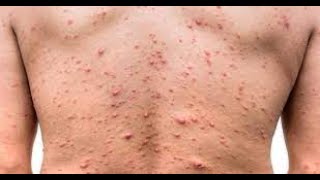 Chickenpox  चेचक में क्या खाएं क्या नहीं  Chicken Pox Me Kya Khana Chaiye Kya Nahi  छोटी माता [upl. by Treva242]