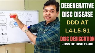 Degenerative Disc Disease DDD L4 L5 L5 S1Disc Desiccation Disc Degeneration Disease Treatment [upl. by Illah]