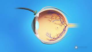 Vitrectomy Surgery for Macular Holes [upl. by Maunsell672]